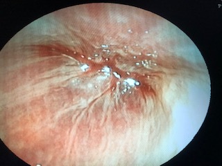 内視鏡検査（胃カメラ）