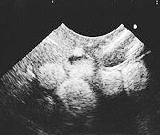 卵胞過剰　診断