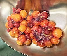 卵胞過剰　診断