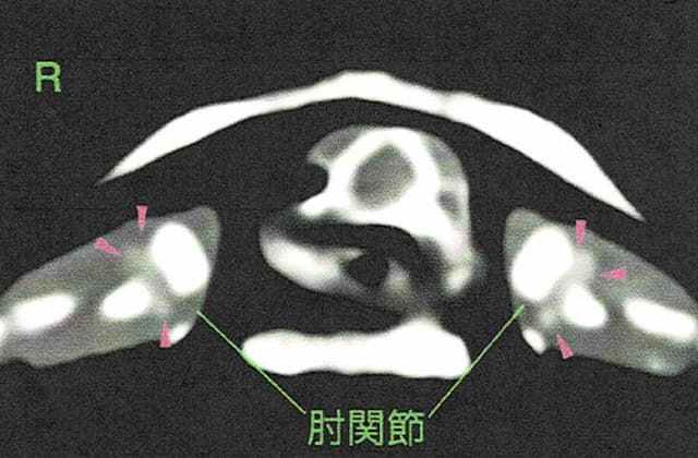 痛風（高尿酸血症）